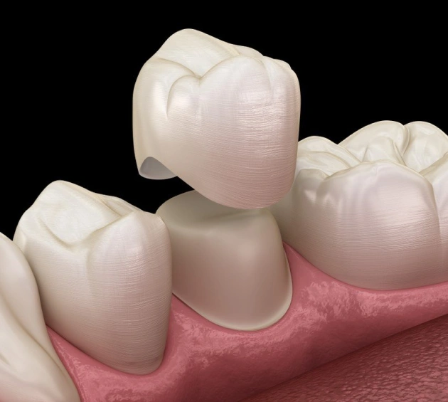 Strengthen and Protect Damaged Teeth With Crowns