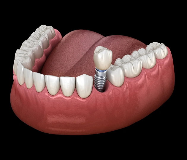 Rebuild Strength and Function With Implant Solutions